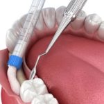 bone grafting in Brandon