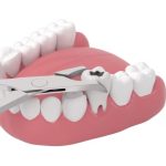 tooth extractions in Brandon