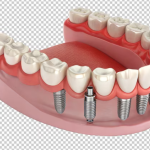 Dental Implants 101: What You Need to Know Before Your Consultation