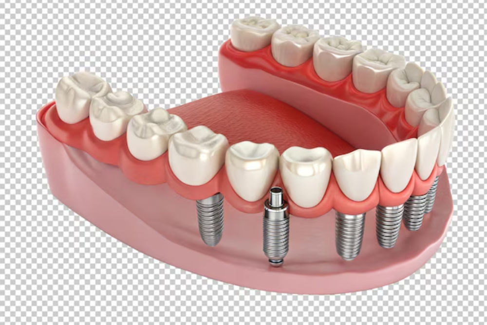 Dental Implants 101: What You Need to Know Before Your Consultation