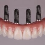 what to expect during the all-on-4 implant recovery process