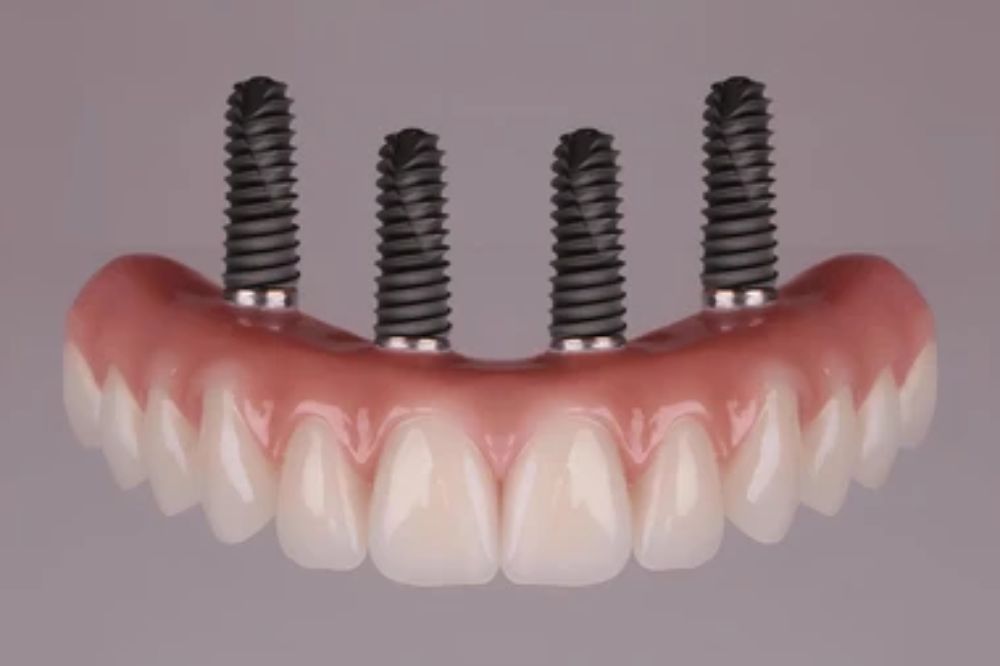 what to expect during the all-on-4 implant recovery process