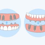 Step-by-Step Procedure of All-on-4 Dental Implants