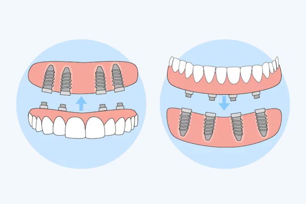 Step-by-Step Procedure of All-on-4 Dental Implants